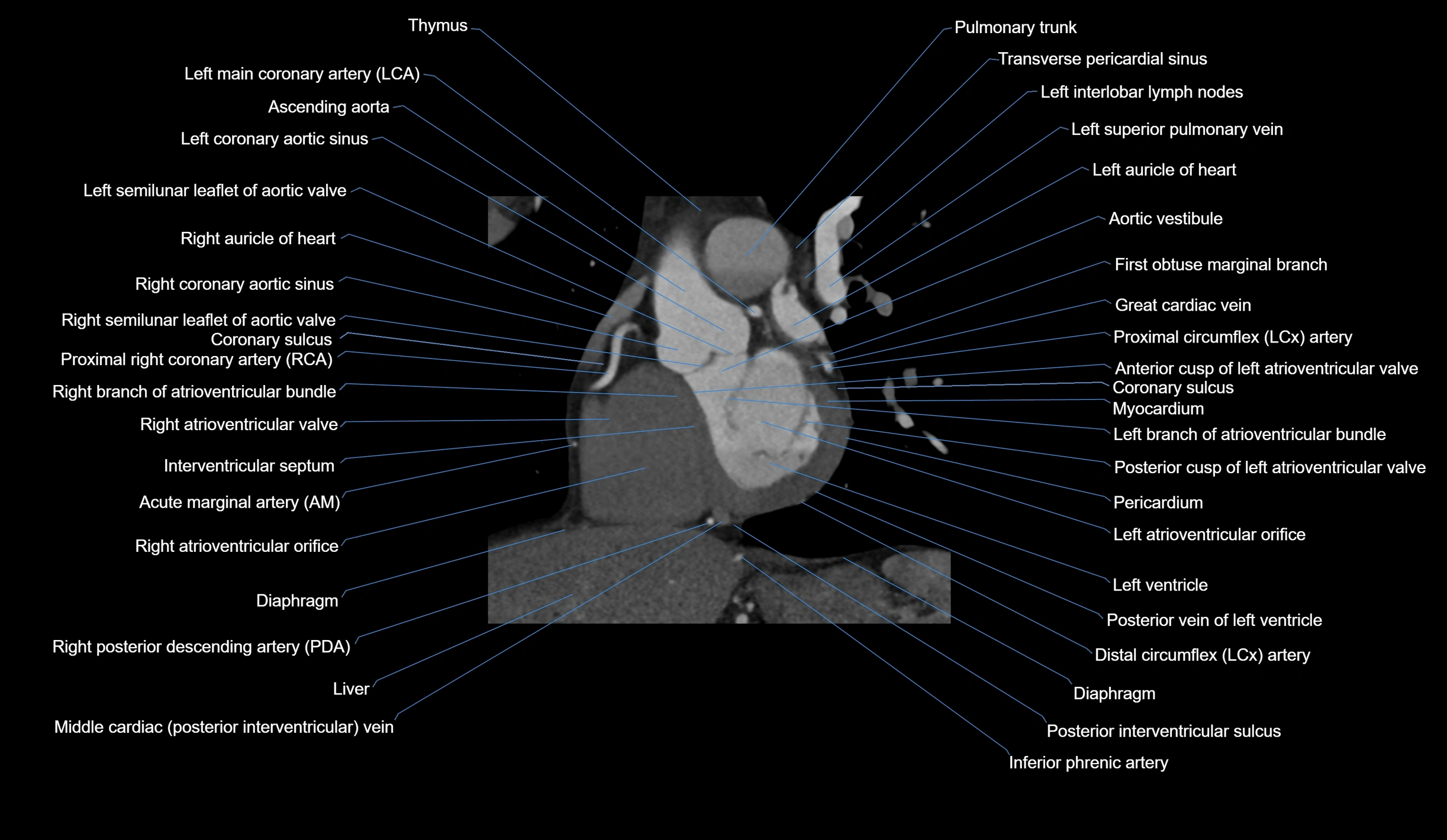 CT heart (coronary angiogram) short axis view  cross sectional anatomy labelled radiology image-00022.webp
